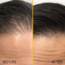 Will a hair transplant work for you