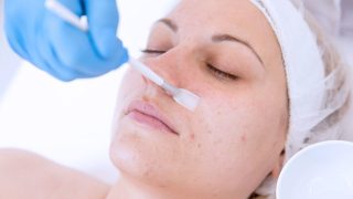 Chemical peel