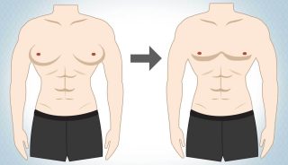 How is gynecomastia treated