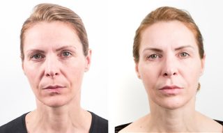 Non-Surgical Face Lift Fillers