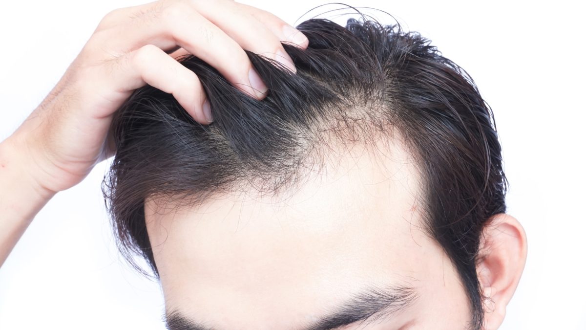 What is Hair loss