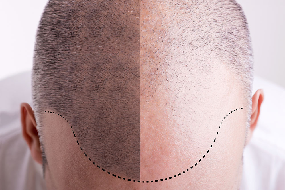 What is Micro-Hair Transplant surgery like