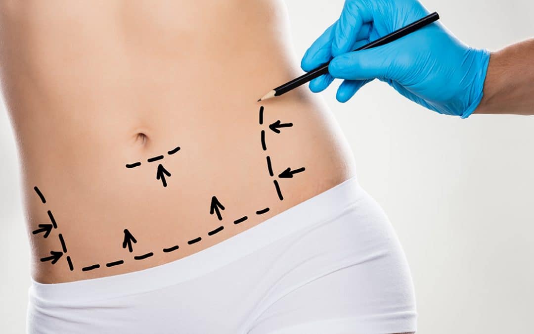 abdominoplasty