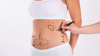 Abdominoplasty