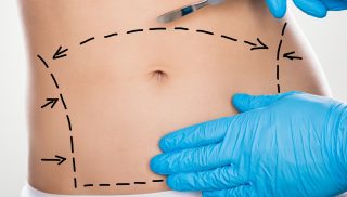 abdominoplasty