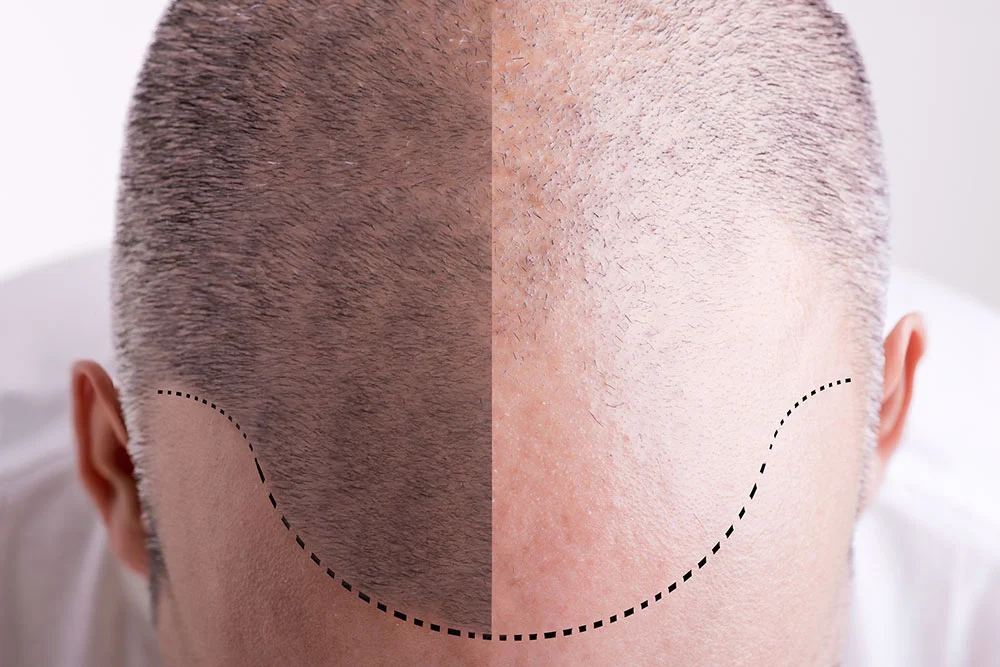 major-causes-and-treatment-of-hair-prp.webp