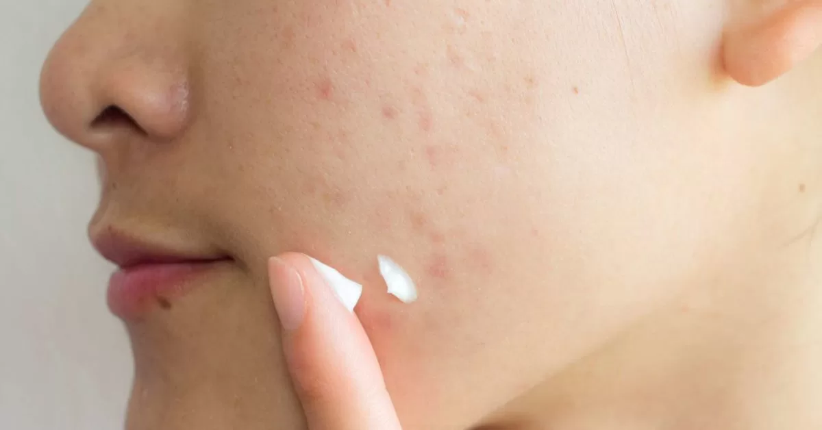 myths-about-acne-scar-jpg.webp
